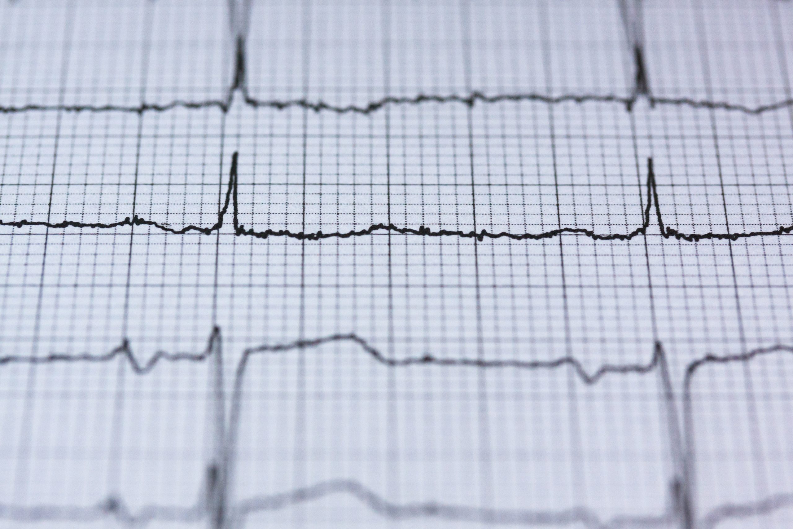 ECG av